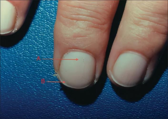 百草益寿:肾好不好,看指甲就知道!肾内科医生教你分辨