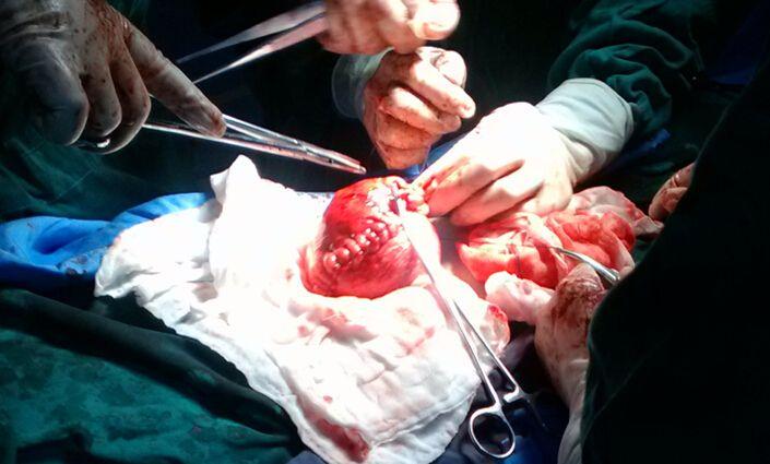 治疗子宫肌瘤少走弯路做健康女人!