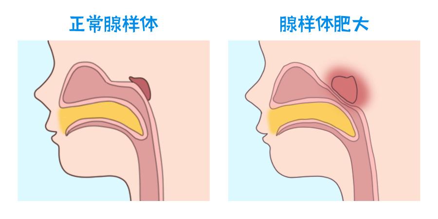 闽江科学传播学者话科普腺样体肥大是什么会给机体带来什么危害