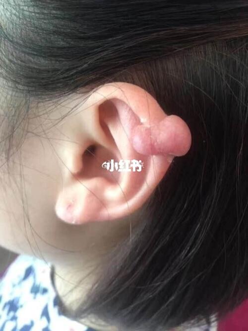 打耳钉而引起的肉瘤_耳钉_耳洞_耳骨_疤痕_发炎_耳朵长肉日记_时尚