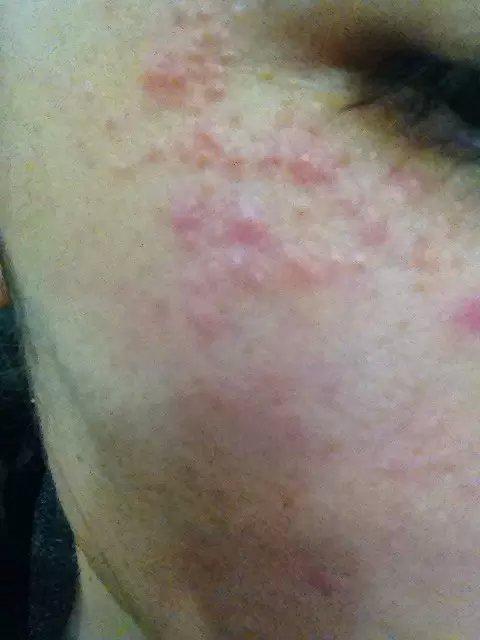 眼睛周围长了很多红的痘痘