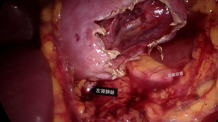 经腹腹腔镜肾囊肿去顶减压术(副本)