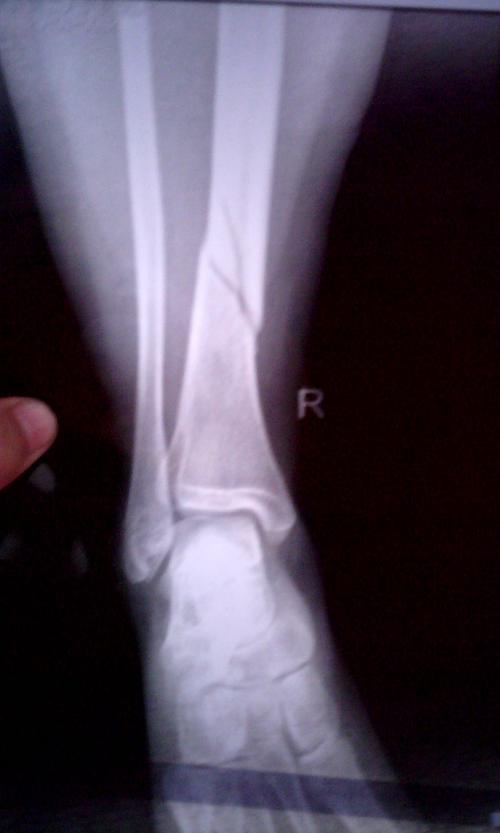 小腿胫骨下端骨折,打石膏要打多久?能完全复位吗?