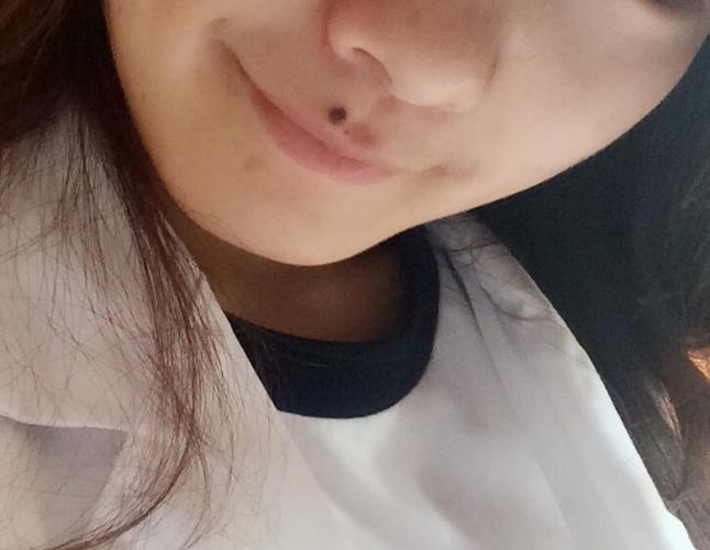 我嘴巴上方长了一颗痣,小时候很小!