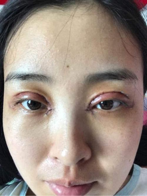 做得双眼皮全切加开眼角,第五天了感觉没好转