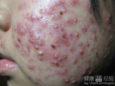 痘痘如何有效治疗?