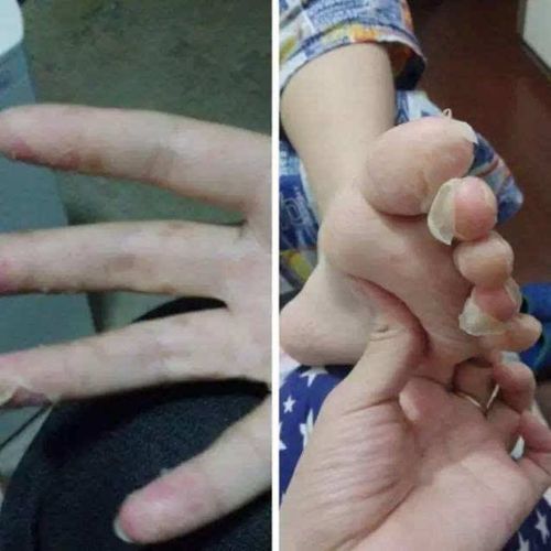 还有十几天,将会有很多孩子感染手足口病.