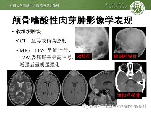 【病例】颅骨嗜酸性肉芽肿1例ct及mr