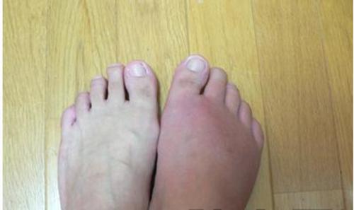 老人容易患有痛风图片