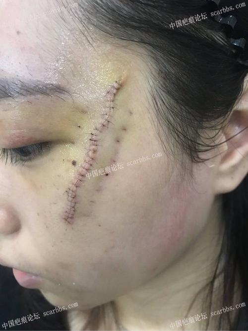 做了疤痕切除上当了九院失败疤痕切除毁容疤痕切除5年恢复图片