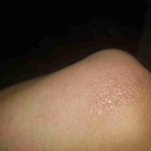 胳膊肘背部起了一层干皮 我也不知道这个位置叫什么?