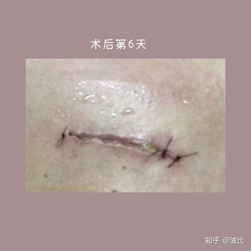 别生闷气啊!记录 乳腺增生 手术过程及术后恢复