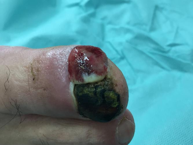 看图识病:化脓性肉芽肿