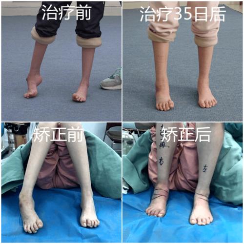 四种方式,教你识别马蹄足内翻