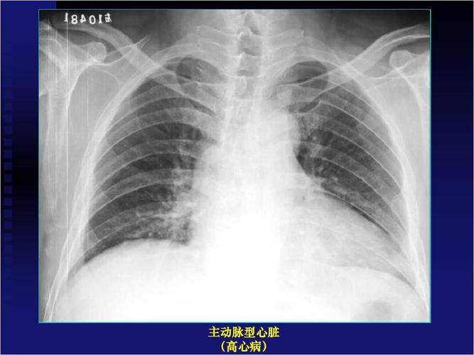 主动脉型心脏 (高心病)