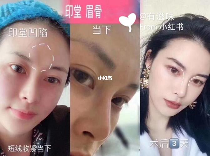 我一直以来印堂印堂凹陷7715,但听说印堂是面相中较为重要的一个