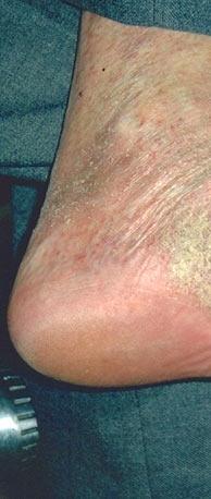 艾滋病患者足部皮肤病变