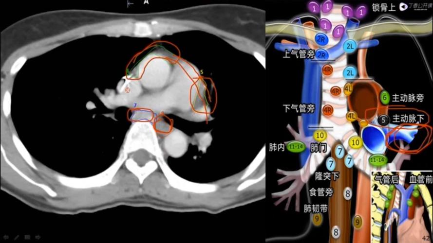 纵隔淋巴结分区的快速记忆