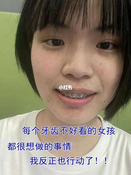 00每个牙齿不好看的女生都该去矫正#宜宾_牙齿矫正