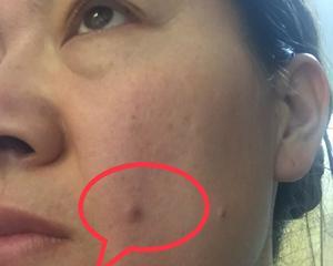 脂肪瘤-痘痘-各类皮肤问题～纯正精油分享