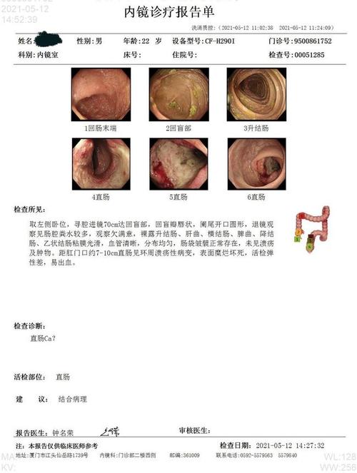 肠镜检查是排查肠道肿瘤的最直接和最好的方法