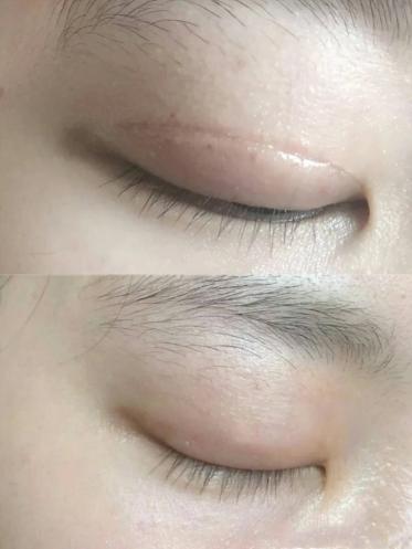 经验分享|热敷|割双眼皮|疤痕增生|双眼皮手术_网易订阅