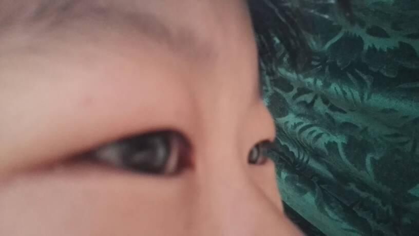 眼睛单眼皮鱼泡眼不动手术怎么变双眼皮?