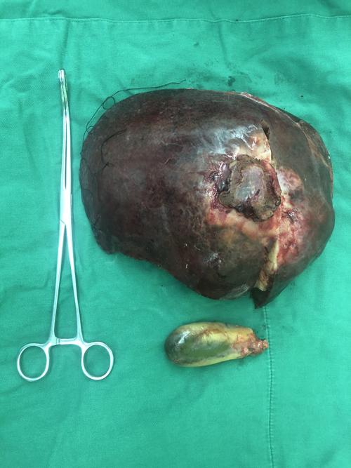 巨大肝癌行右半肝切除手术1例