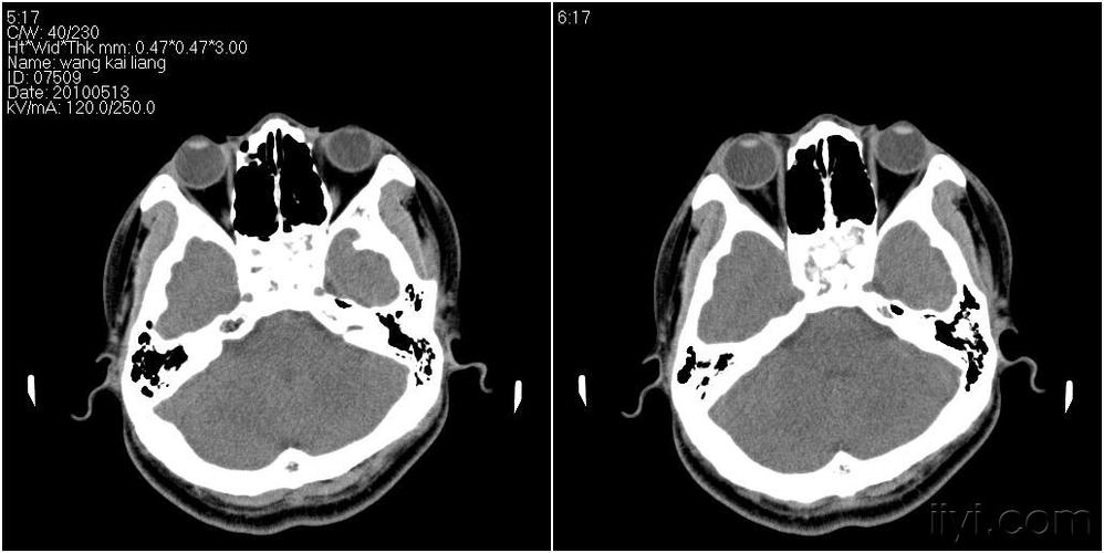 男性27岁患者要求头颅扫描发现蝶窦病变