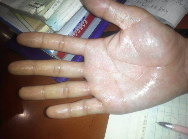 手掌出汗的厉害!看一下下面的照片!不是