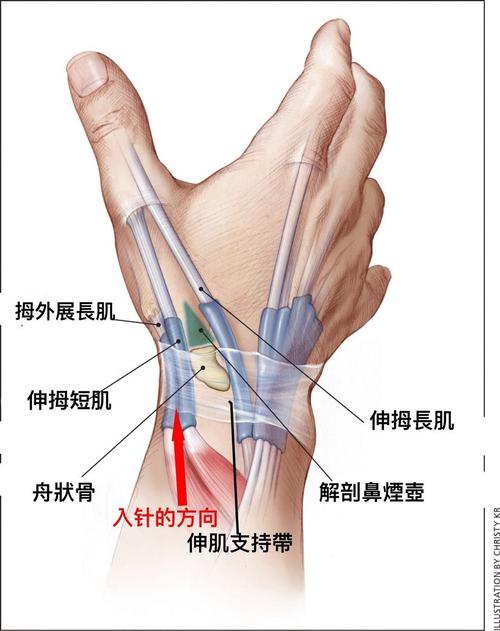 桡侧茎突狭窄性腱鞘炎,拇长展肌和拇短伸肌腱在经过桡骨茎突
