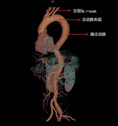 激光原位开窗术 清华长庚成功救治主动脉夹层患者_支架