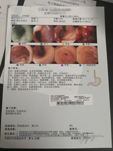 萎缩性胃炎三年复查一下胃镜行不行?_慢性萎缩性胃炎