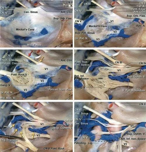 海绵窦脑膜瘤手术要点| the neurosurgical atlas全文