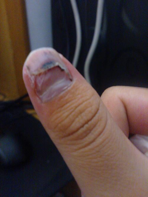 手指甲成这样了 可以用什么药让它长快点么