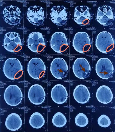 橙色圆圈为肿瘤切除后留下的空腔,红色箭头所指为术野凝血块和止血
