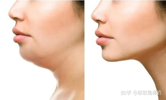 下颌线对侧颜影响大吗?