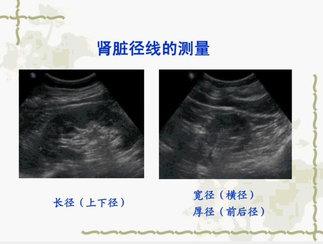 正常肾脏的超声诊断