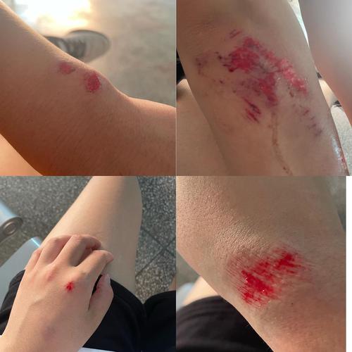 刚摔时手上的伤口