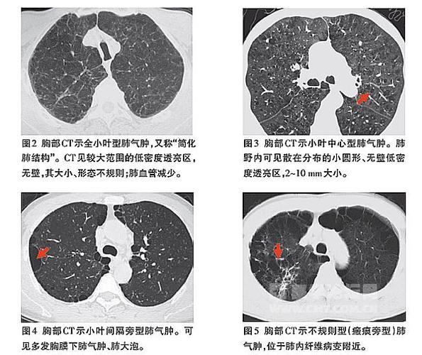肺气肿及肺心病的影像学特征