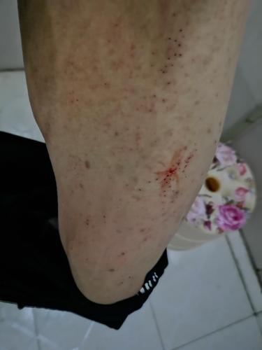 病情描述: 一开始上厕所尿道痛,现在尿道不痛了,皮肤痒.