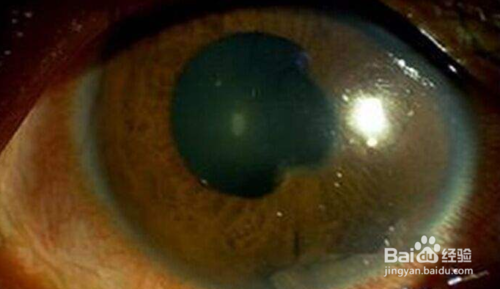 白塞氏病(丝绸之路病)