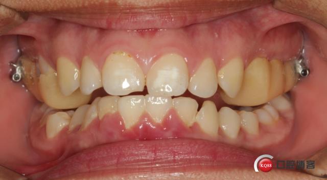 自制sgtb矫正骨性二类错合一例