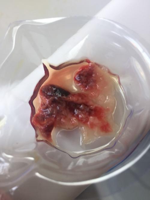 血腥慎入,这是绒毛膜吗?