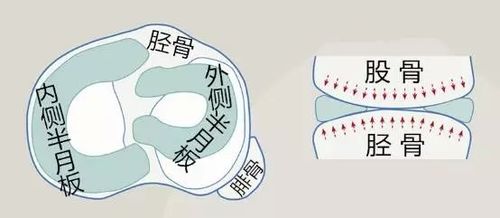 半月板损伤最大的危害在于当行走和运动时会导致膝关节的软骨磨损及