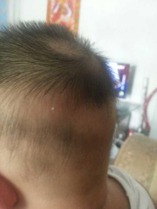 宝宝头上长个白点,有点像脂肪粒,有没有