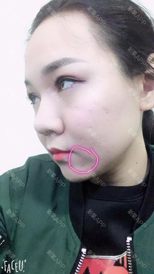 今年二十出头,从小就鼻唇沟深,而且嘴角下_圈子-新氧美容整形
