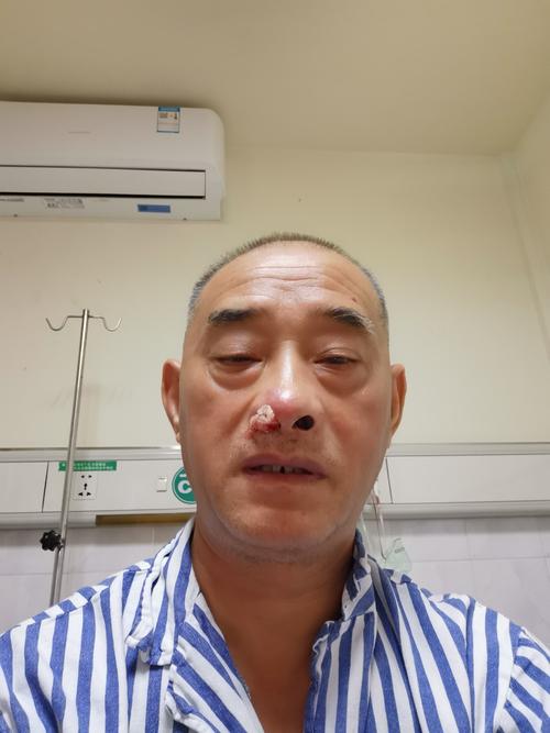 惊心动魄的鼻炎手术治疗经历