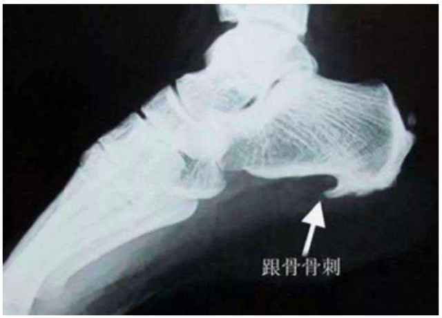 狐大医 | 骨刺是"好东西"!但为啥不招人待见