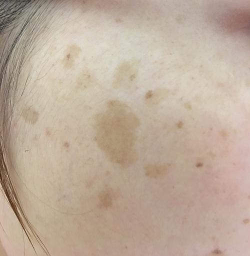 近几年脸上斑越来越多,不知道是什么引起的,这些是什么斑啊,怎么防